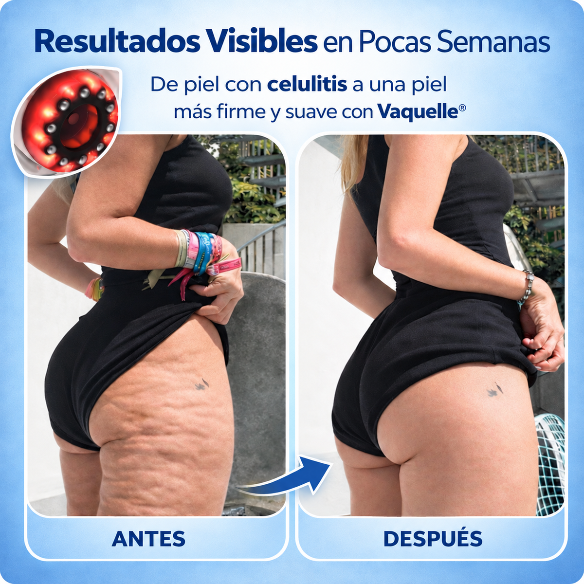 Vaquelle® Masajeador Anticelulitis con Luz Roja y Azul
