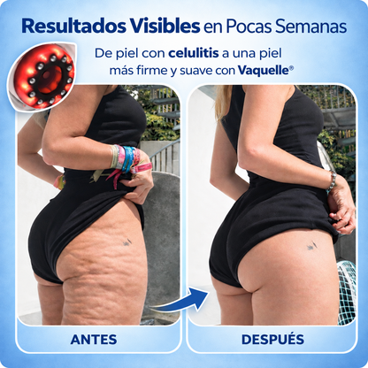Vaquelle® Masajeador Anticelulitis con Luz Roja y Azul